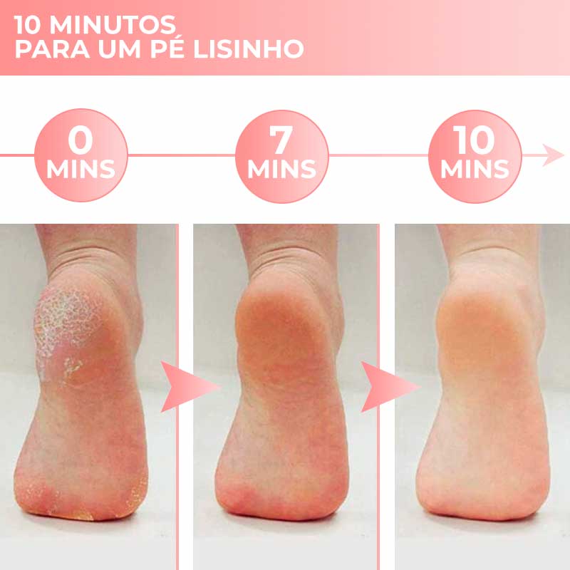 PedicurePro - Removedor De Calos e "Cascão" Dos Pés